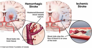 Perbedaan stroke perdarahan dan sumbatan